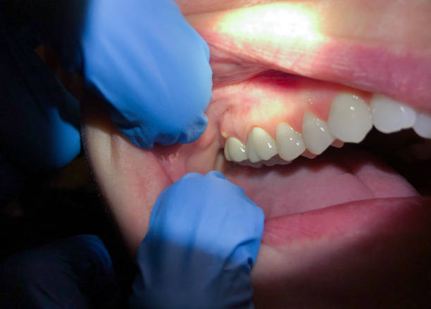Best Emergency Dental Extractions in Ridgeway, VA