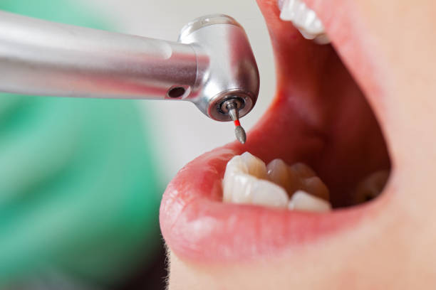 Best Broken or Cracked Tooth Emergency Dentist in Ridgeway, VA